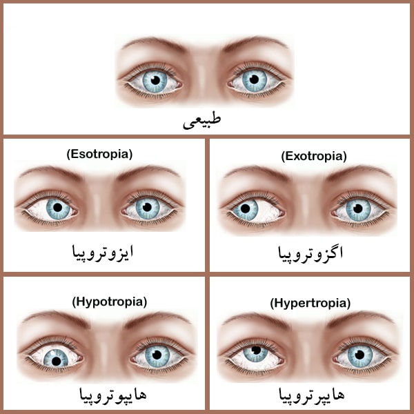 انواع انحراف چشم (استرابیسم)